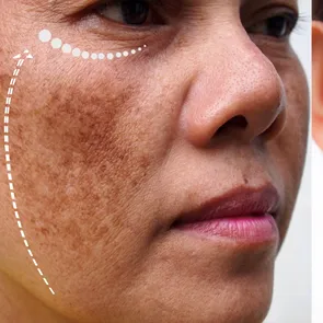 Scapă de petele pigmentare cu o mască naturală din trei ingrediente. Secretul unui ten de porțelan