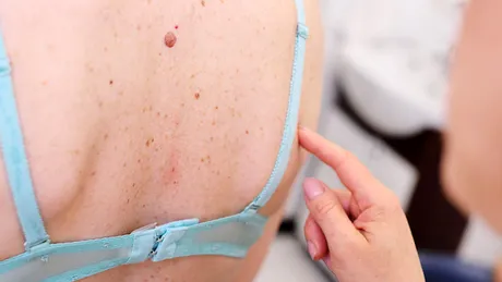 Cancerul de piele: controlul aluniţelor şi biopsia