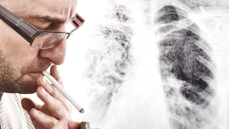 Peste 10.000 de români mor în fiecare an din cauza unui tip de cancer cauzat de fumat. 5 semne că trebuie să mergi la medic