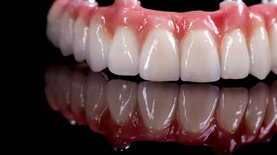 (P) Proteza fixă cu 6 implanturi: ghid complet despre etape, prețuri și beneficii