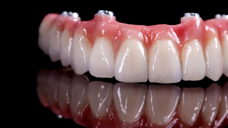 (P) Proteza fixă cu 6 implanturi: ghid complet despre etape, prețuri și beneficii