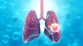 Care sunt cele mai indicate tratamente pentru cancerul pulmonar?