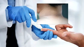 Medicii avertizează: o pată închisă la culoare pe piele poate fi un semn al diabetului de tip 2