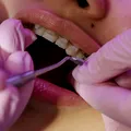 (P) 5 motive pentru care merită să alegi un aparat dentar din safir