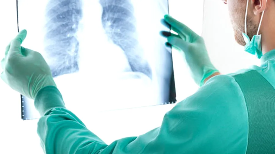 Cancerul pulmonar poate să rămână în stare latentă chiar şi 20 de ani