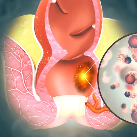 6 simptome înșelătoare ale cancerului de colon, pe care le poți observa dimineața, după trezire