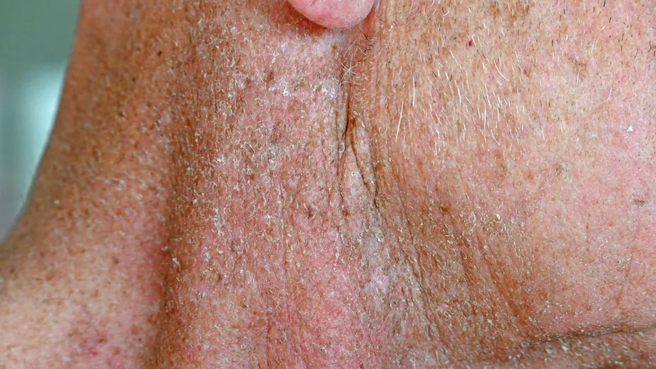 Radiodermita sau dermatita de radiație – cum se tratează pielea afectată de radioterapie prin nanolipofilling