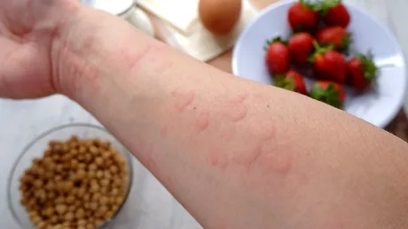 Cum îți dai seama că ești alergic la un aliment. Semne care apar pe piele și alte reacții ale organismului