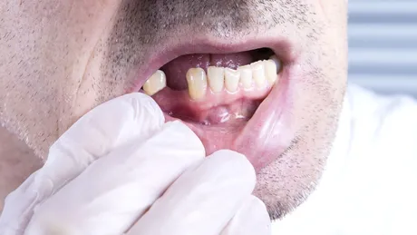 Parodontoza, boala care ne lasă fără dinți de la 30-40 de ani. Cum poate fi prevenită