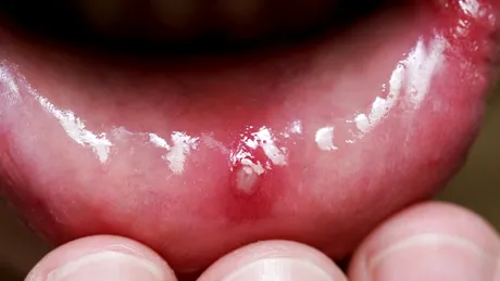 Ulcerele aftoase: simptome, tratament