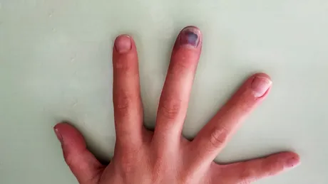 Semnul „tăcut” de pe unghii care îți arată dacă ai cancer