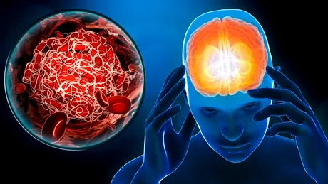 Cum să recunoști simptomele unui accident vascular cerebral:  sfaturile neurologului