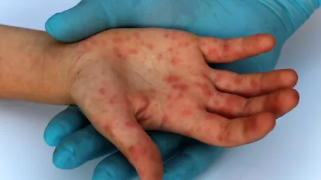 Primul caz de variola maimuței, depistat în România. Este un tânăr de 26 de ani, din București
