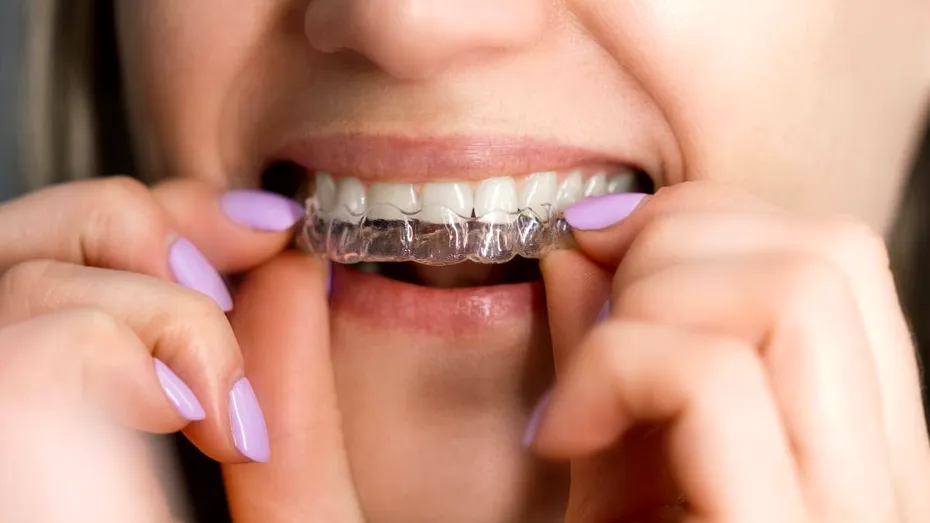 Ortodonția în 2025 – nu mai e ce era: fără brackets, fără metal, fără vizite lunare. Simplu, dar eficient, în același timp