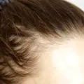 Slăbești, dar îți cade părul? Ce legătură au injecțiile pentru slăbit cu alopecia