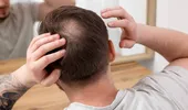 De ce cade părul diferit la femei și bărbați. Greșeala pe care mulți o fac atunci când aleg tratamentul