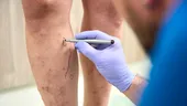 Vitamina care poate susține sănătatea vaselor de sânge și reduce riscul de varice