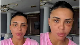 Andreea Popescu, dezvăluiri despre ultimele operații suferite: „Mi-a căzut părul enorm”. Ce intervenții estetice și-a făcut vedeta