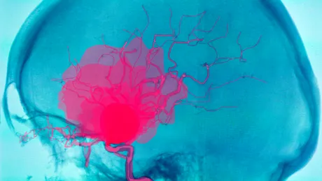 Cum se depistează rapid un AVC ischemic. Timpul înseamnă neuroni!