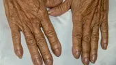 Aspectul degetelor și al feței poate da de gol cancerul pulmonar