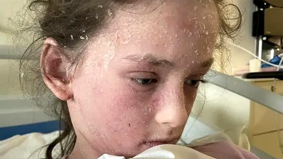 Boala rarisimă cu care a fost diagnosticată această adolescentă. E alergică la propriile lacrimi, dar nu doar atât