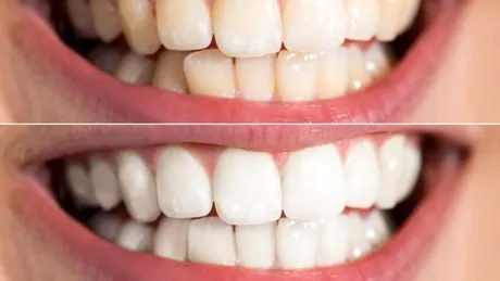 Cel mai accesibil preț la albire dinți și tot ce trebuie să știți despre această procedură
