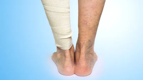 Tratamentul ulcerului venos/varicos: ce sunt ulcerele venoase, cum se manifestă, care sunt cauzele, cum se tratează