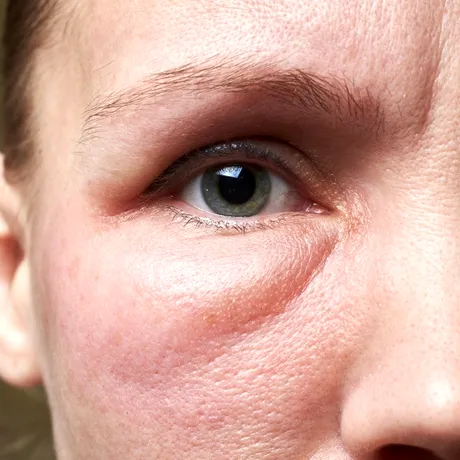 Semnele ascunse ale problemelor renale. Ce spun ochii umflați