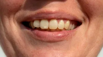 Alimente dăunătoare pentru dinți. Efectul lor e nociv pentru sănătatea orală