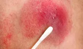 Cum îți dai seama că ai o infecție cu stafilococ. 4 semne care apar pe piele – furunculul e unul dintre ele!