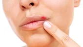 Simți că îți apare herpes? Ce să faci imediat ca să nu erupă
