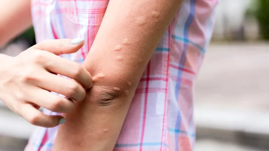 10 motive pentru care eşti un magnet pentru țânțari