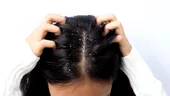 Cum poți scăpa de mătreață în mod natural. Obiceiurile care pot reduce exfolierea scalpului și preveni reapariția ei
