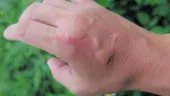 Mușcătura de furnică: remediul simplu care calmează rapid durerea și mâncărimea