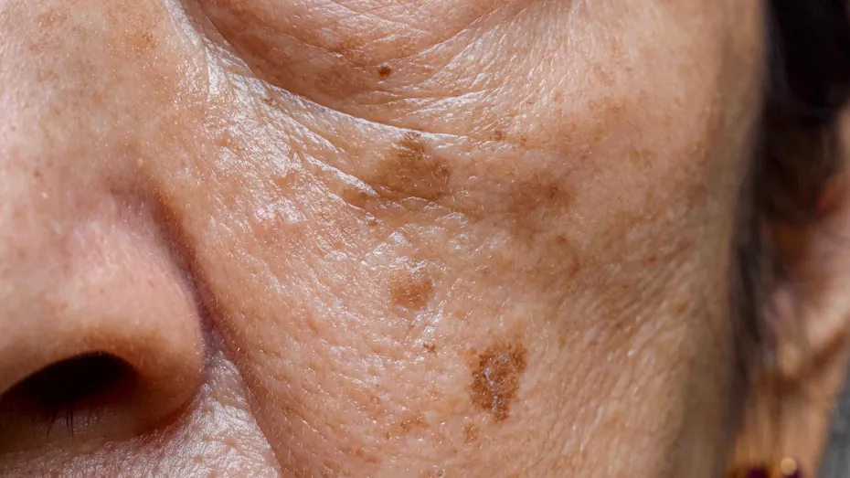 20 de semne care apar pe piele când ai ficatul bolnav