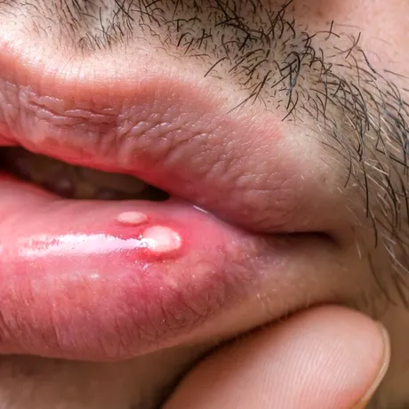 Cum scapi mai repede de afte. Remediile naturale care calmează durerea și grăbesc vindecarea