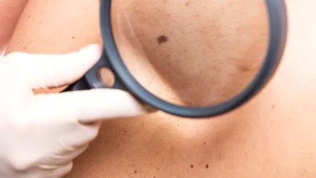 5 semne că o aluniţă este canceroasă. Cum arată melanomul, cel mai agresiv cancer de piele