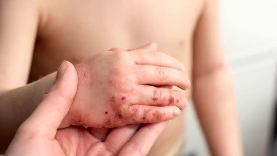 Piodermita: Cum recunoști „infecția ascunsă a pielii” și cum o tratezi rapid