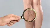 Scapă de varice fără medicamente. Rețeta naturistă care îți salvează picioarele