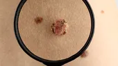 Identifică acasă aluniţele cu potenţial cancerigen