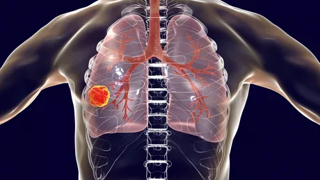 Cancerul pulmonar este cel mai agresiv tip de cancer din lume