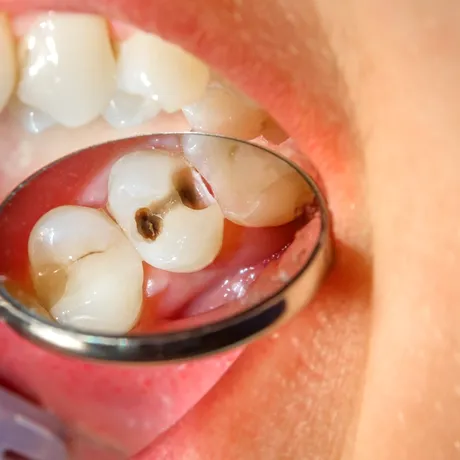 Cum să scapi de carii. 10 metode naturale pentru dinți sănătoși