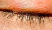 Senzația de nisip în ochi, pleoapele umflate, ochii lipiți și alte 7 simptome de blefarită. Infecția cu stafilococ auriu este una dintre cauze