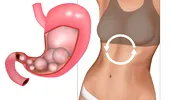 Ești balonată tot timpul? Ce alimente și boli pot cauza balonare și gaze intestinale