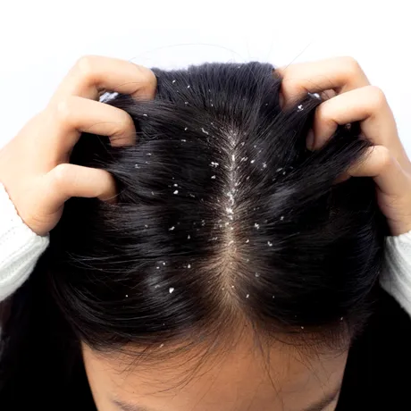 Cum poți scăpa de mătreață în mod natural. Obiceiurile care pot reduce exfolierea scalpului și preveni reapariția ei