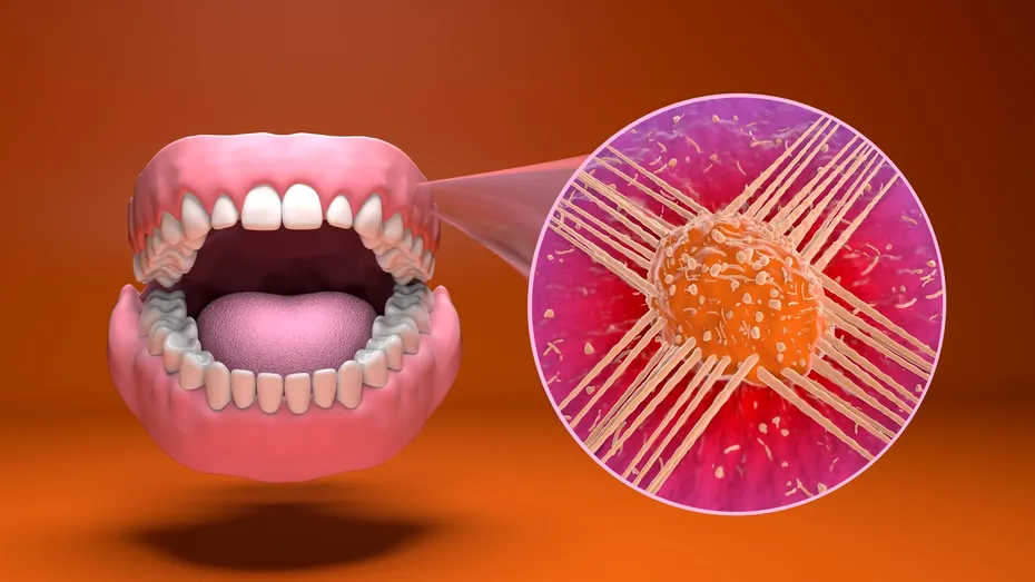 Dieta pentru prevenirea cancerului oral. Cum să te protejezi prin alimentație