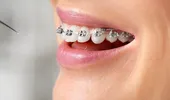 (P) 5 semne clare care indică că ai putea avea nevoie de aparat dentar