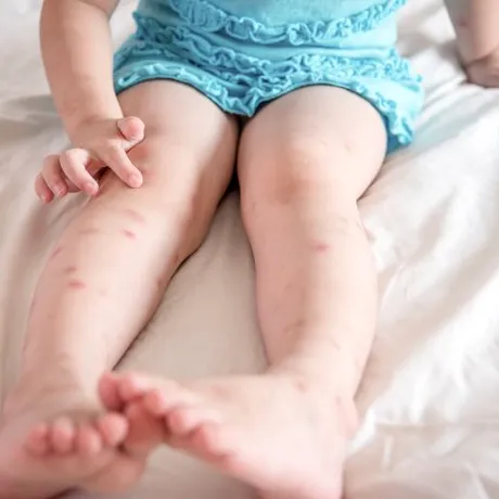 10 boli transmise de țânțari. Protejați-vă copiii, pot apărea complicații! Semnele la care să fiți atenți