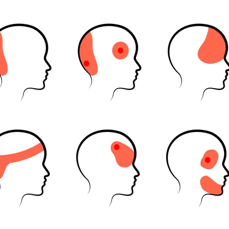 Ce înseamnă durerea de cap resimțită în tâmple, frunte sau în partea dreaptă și pastile pe care trebuie să le iei