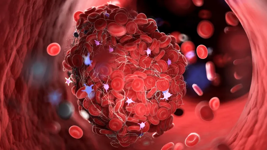 Trombofilia nu este o boală, ci un factor de risc în apariția cheagurilor de sânge